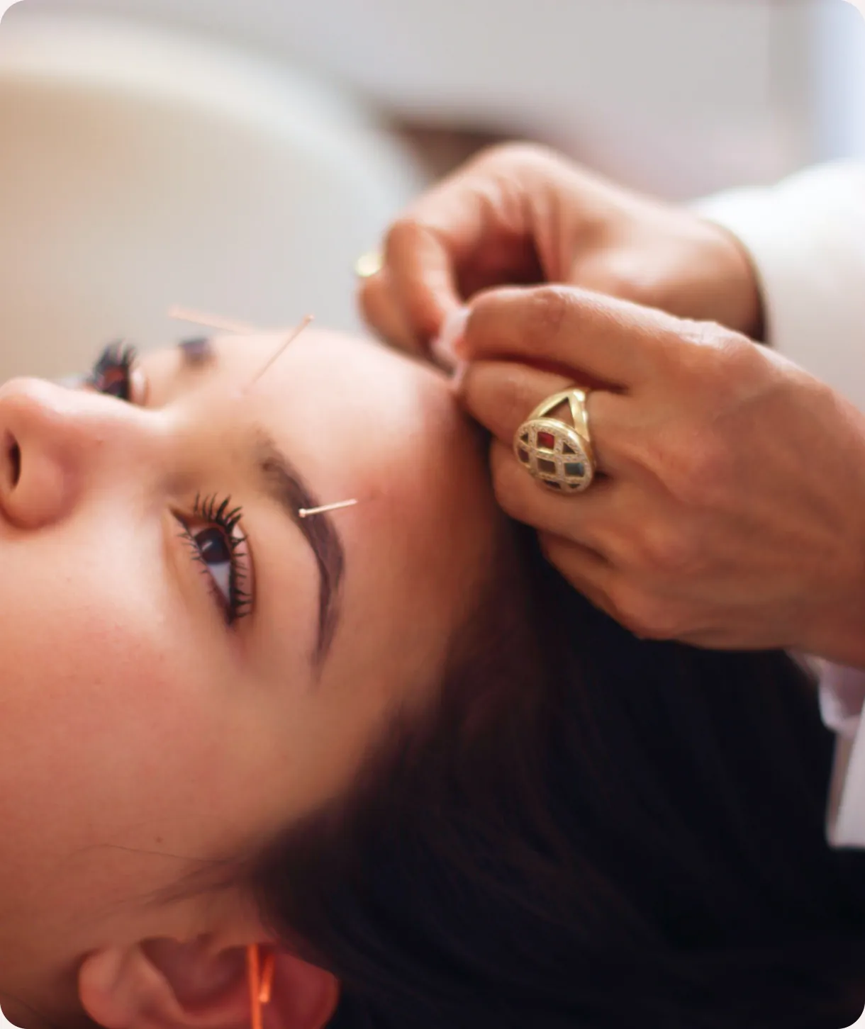 Pinky Lalwani placing fine acupuncture needles on a patient’s forehead