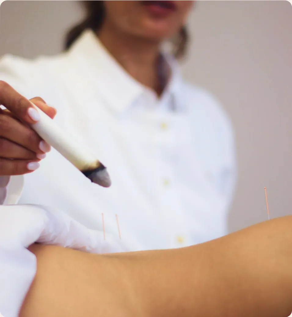 A lit moxa stick held above acupuncture points on a patient’s arm