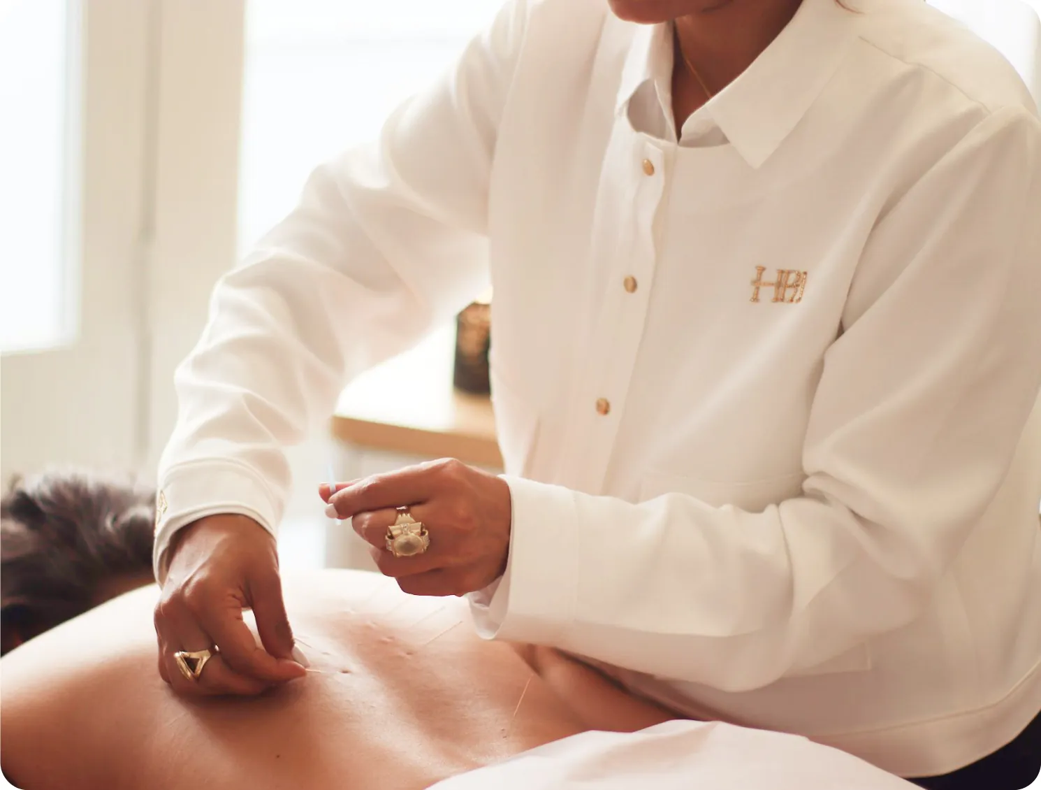 Acupuncture needles being placed along a patient’s back