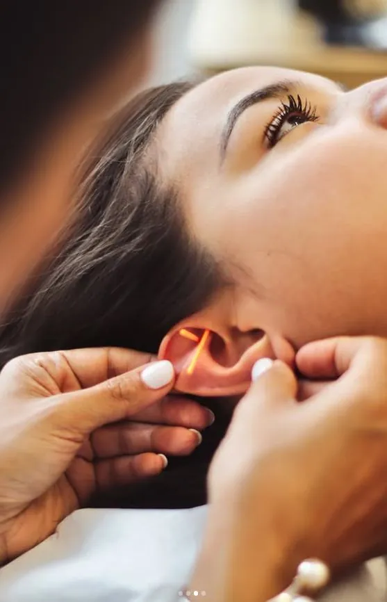 Auricular acupuncture on the ear