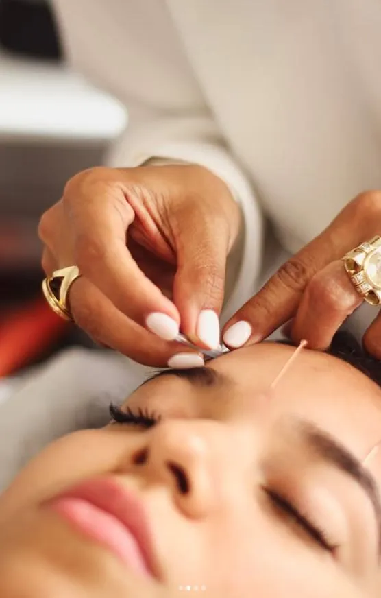 Facial acupuncture treatment