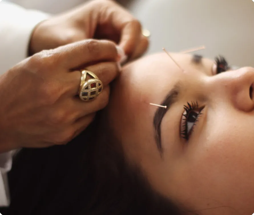 Facial enhancement acupuncture needles placed on the forehead